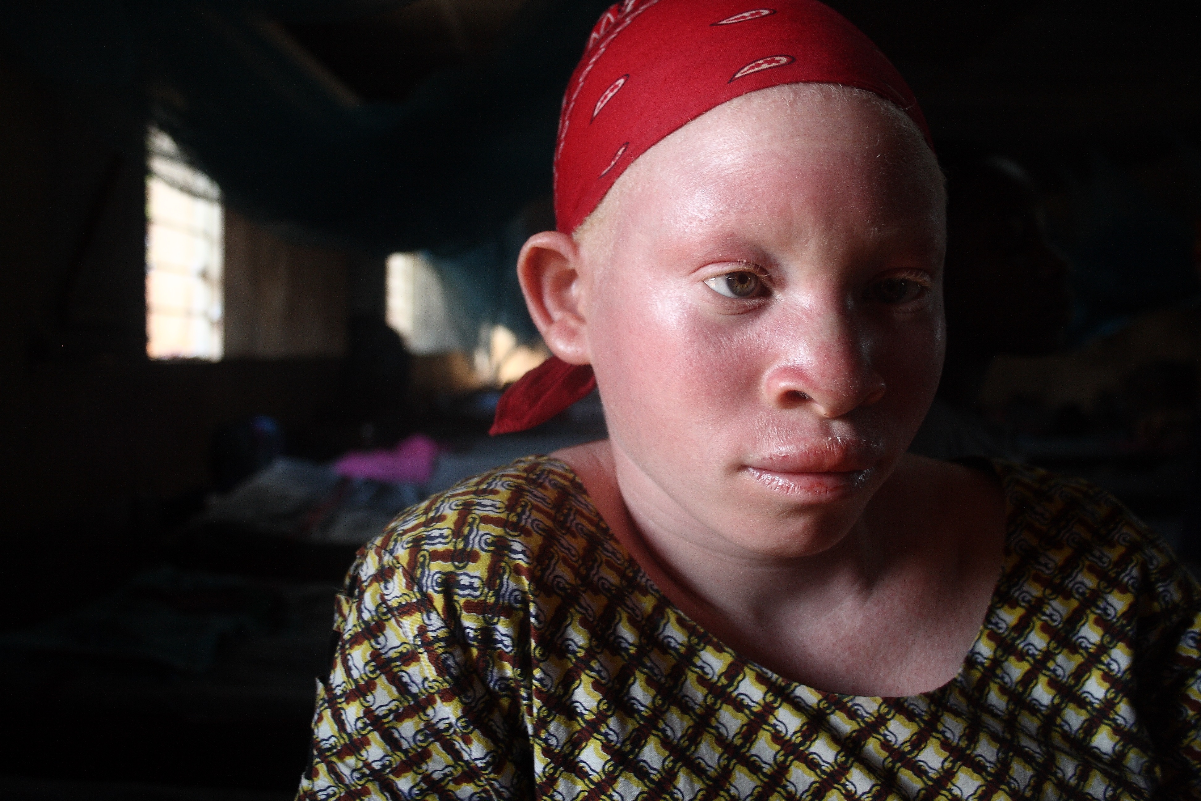Albino girl