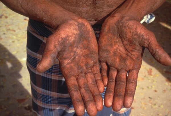 Hands of an arsenicosis patient in southern Bangladesh.