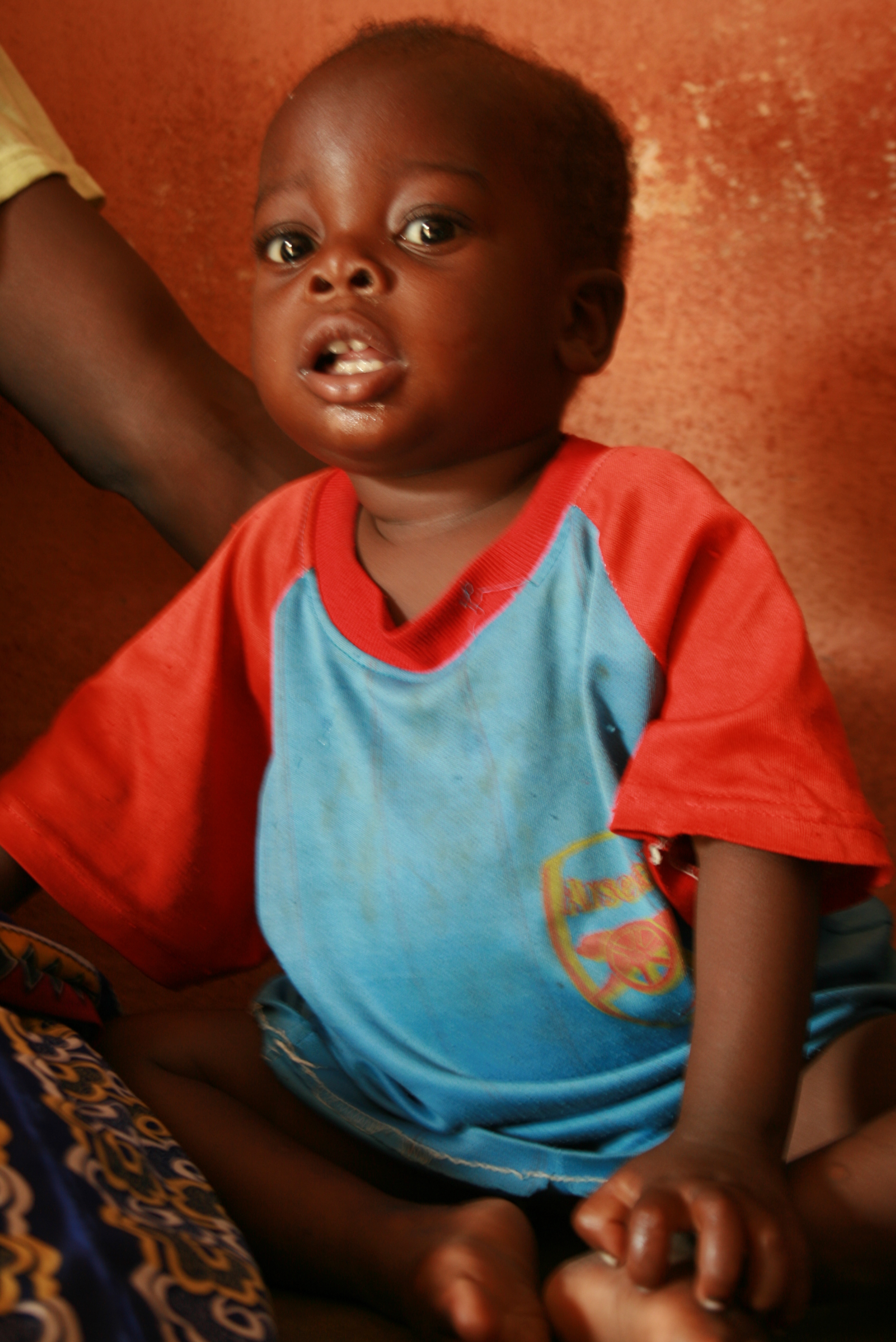Malnourished two-year old child in Lotougou village in northern Togo waits for his weigh-in