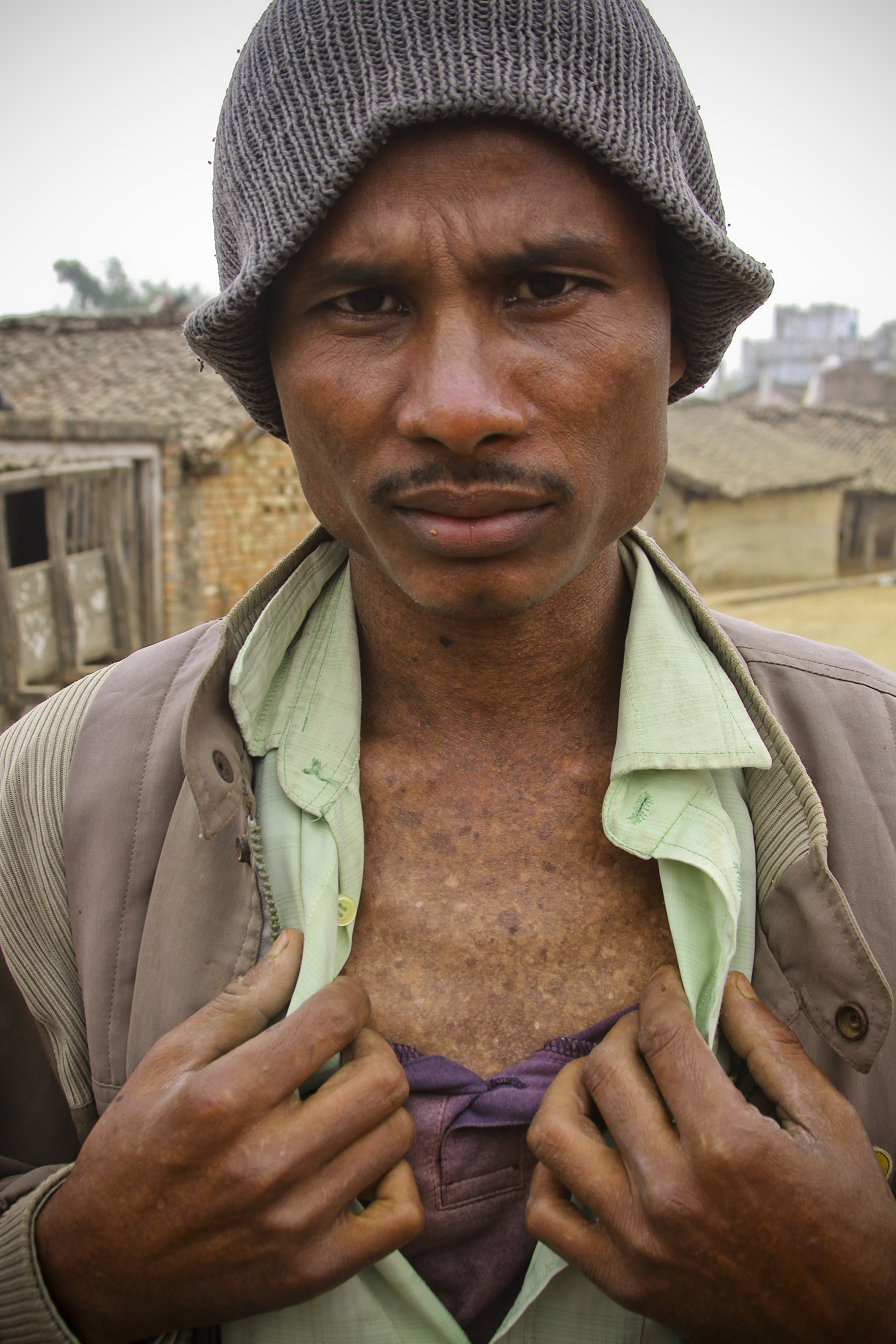 A 29-year-old man in Nawalparasi District in Nepal shows his blotched chest, a symptom of arsenic poisoning