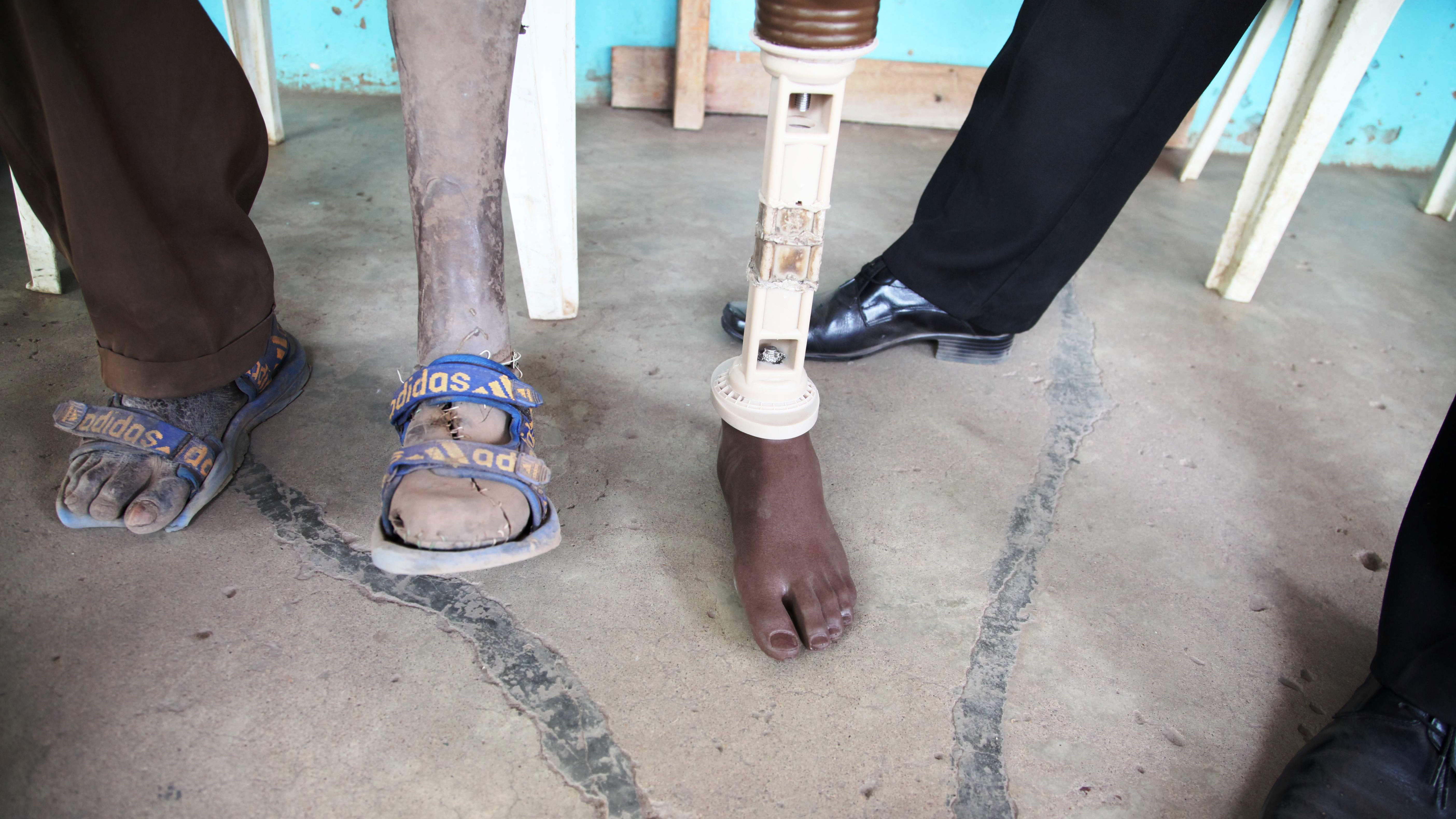 South Sudan's two decade-long war left some 50,000 people seriously injured