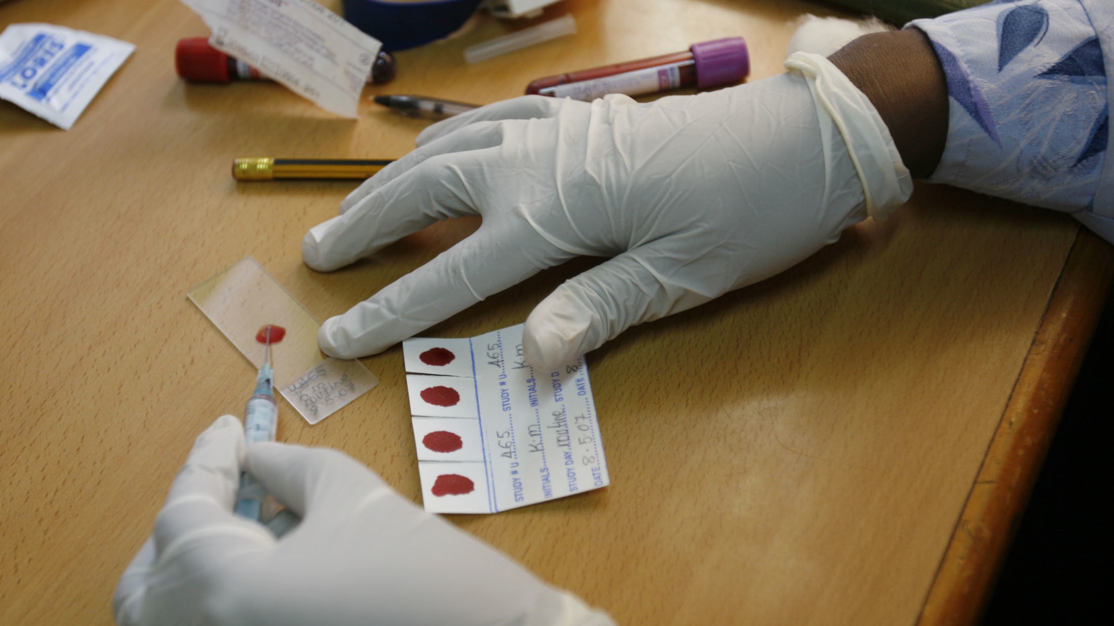 Blood samples being prepared for analysis as part of the malaria trial at the MU-UCSF Malaria Clinic of the Mulago Hospital