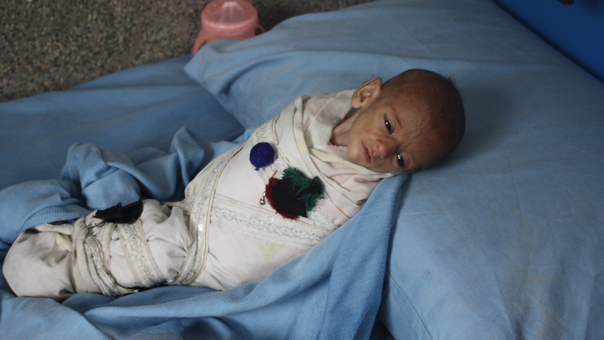A severely malnourished child in the Afghan city of Jalalabad, east of the capital Kabul. Afghanistan has some of the highest rates of malnutrition in Asia.