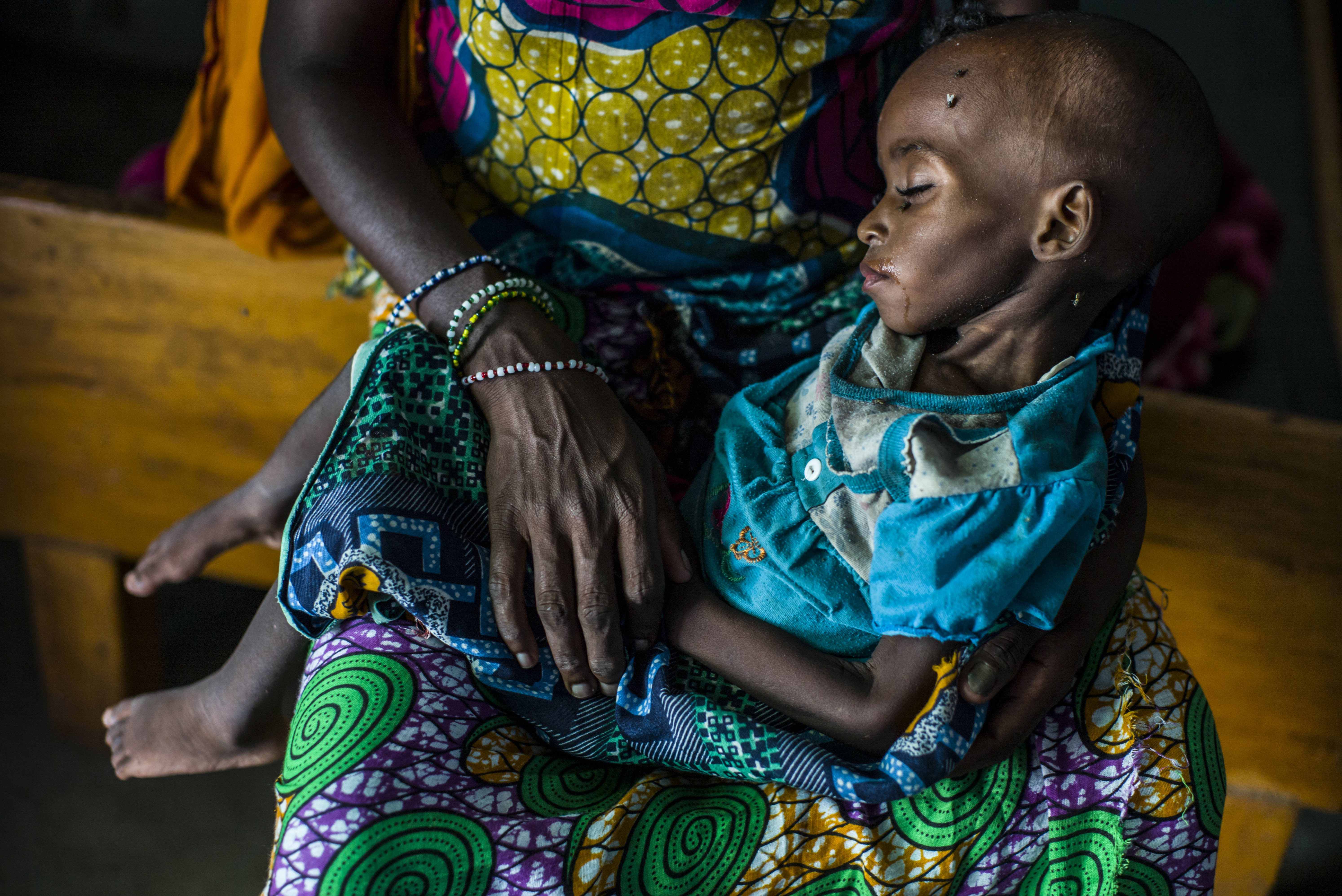 Eighteen-month-old Aishatou is treated for acute malnutrition at Gore hospital in Chad. Her mother, Fatouma, arrived with her at Dosseye refugee camp two weeks earlier, after walking for a month in the bush to escape violence in the Central African Republ