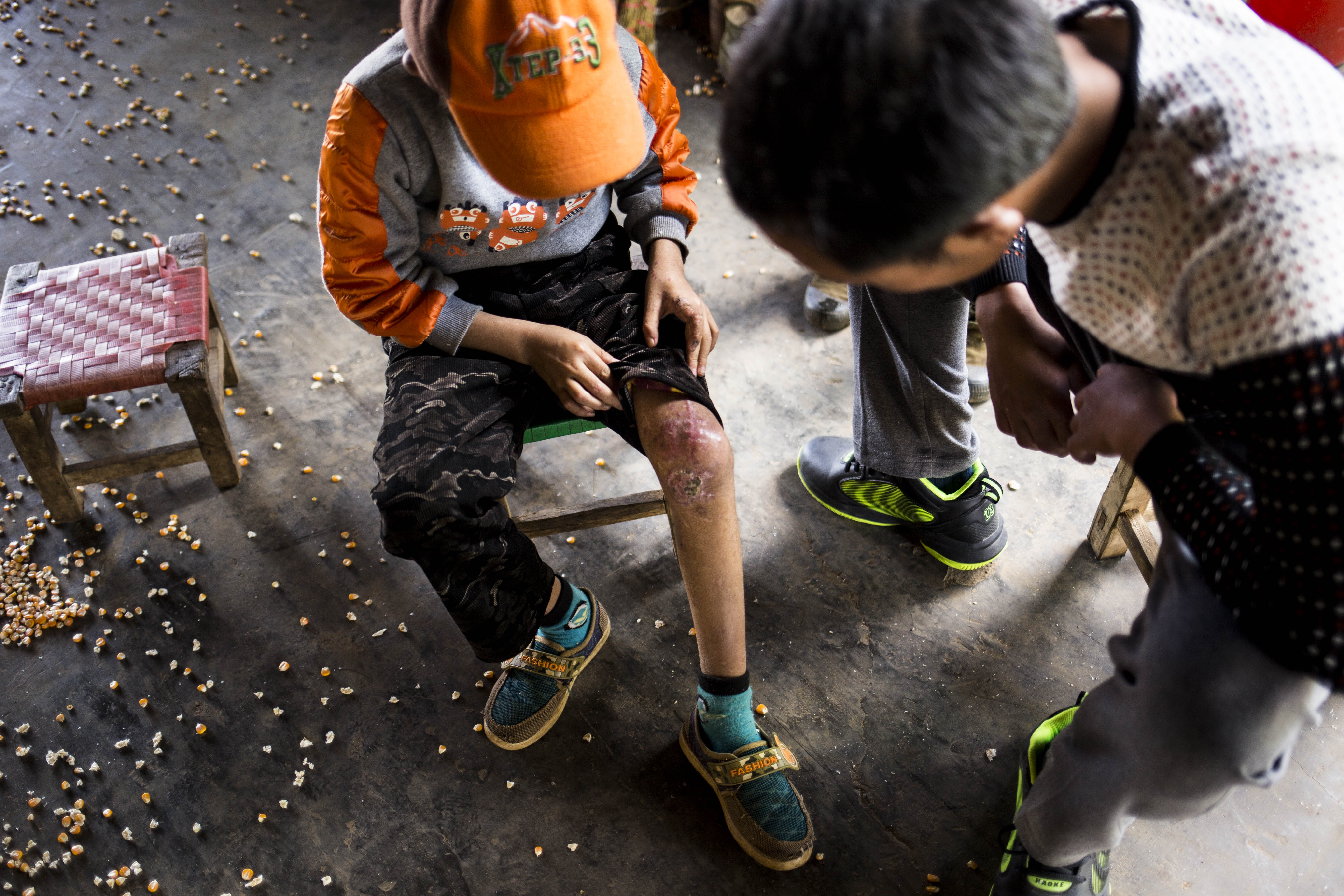 Luo Ben Qing, 10, is shown in November 2015 displaying injuries he received in a landmine explosion in Myanmar's Shan State