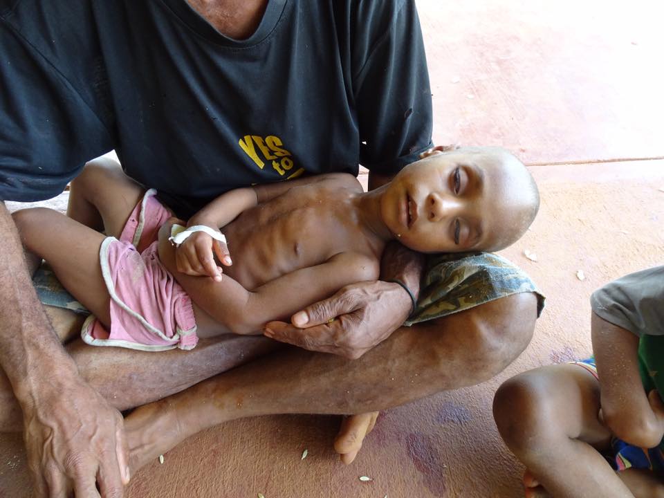 A malnourished child in January 2016 in Mougulu, Papua New Guinea, where crops were killed by drought and frosts linked to El Nino