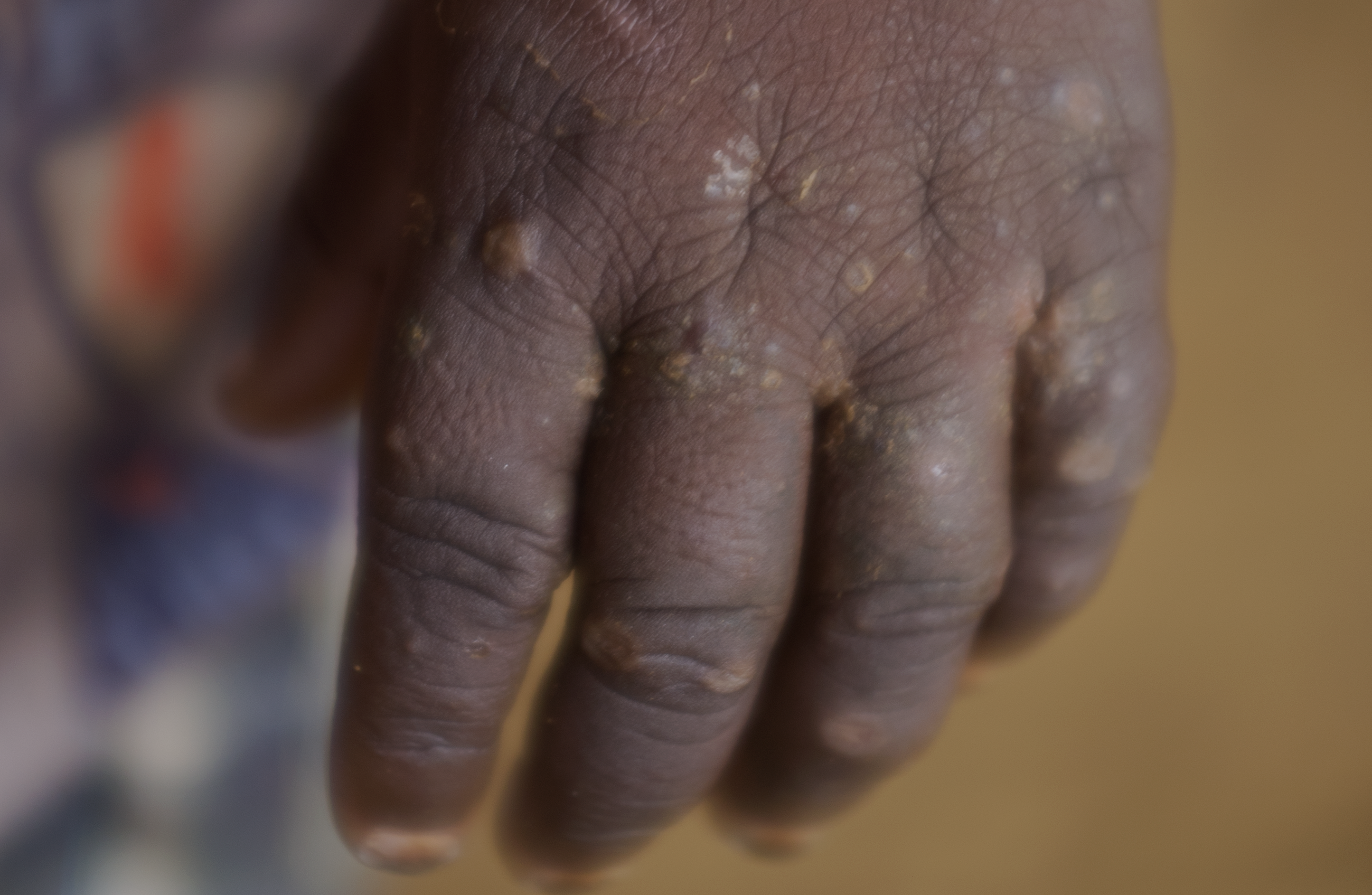 Child's hand with rashes that his mother attributes to the mine's poisonous leak