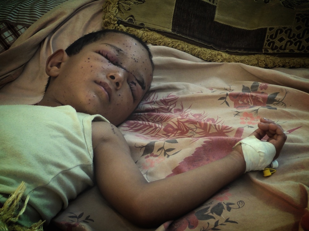 A child with eye injuries lies on a bed.