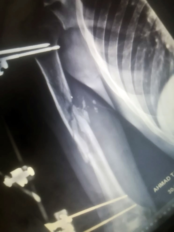 An X-ray image of the arm of a patient named Ahmad, who was shot three times