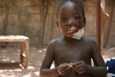 A girl suffering from the noma disease at a clinic in Ouagadougou run