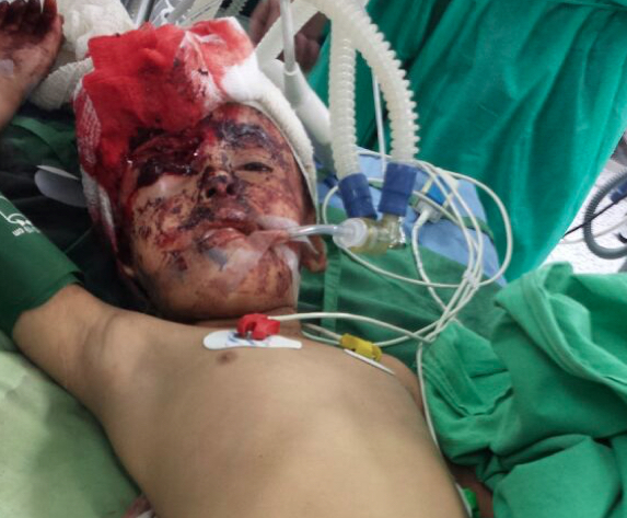 Children bear brunt of Yemen’s war Amel Naser six receives treatment at the military hospital in Sanaa Shawb district Sana'a after suffering injuries in her eye face and leg from the explosion caused by the Noqum mountain attack in May 2015