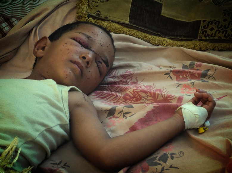 Four-year-old Faiz al-Olfi lies sleeping in al-Naqeeb hospital in Yemen’s southern city of Aden, his face speckled with tiny shrapnel wounds