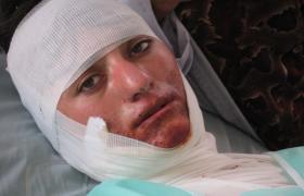 Domestic violence force some Afghan women to self-immolation.
