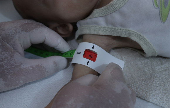 Doctor Firas Hamdo measures an infant’s arm to check for indications of malnutrition at al-Nour hospital in Idlib province.